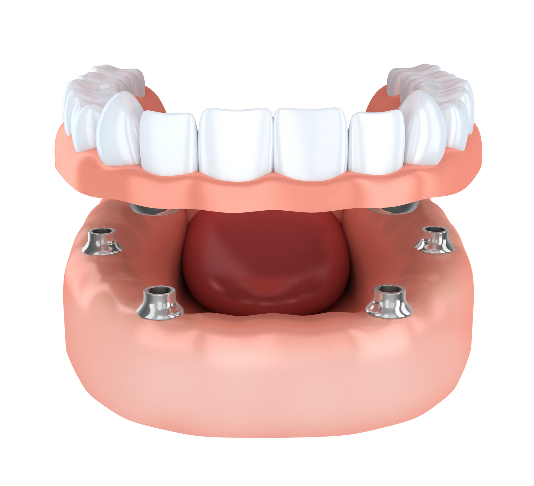 Watergate Dental offers implant-supported prosthetics