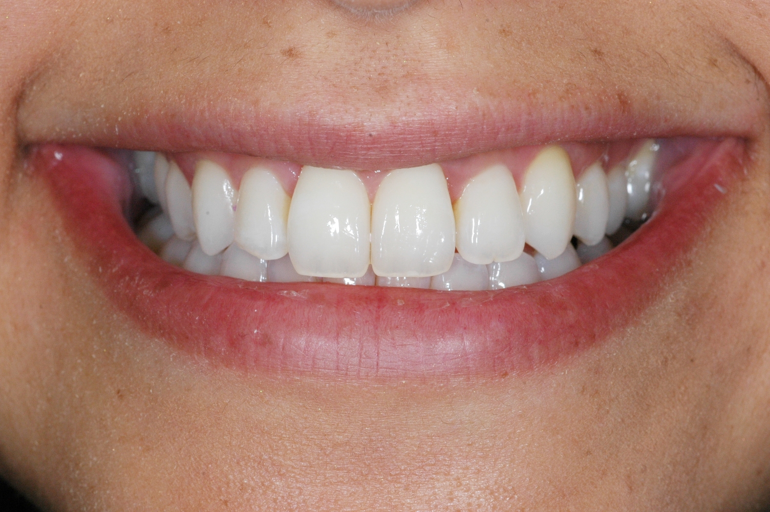 Invisalign at Watergate Dental - After