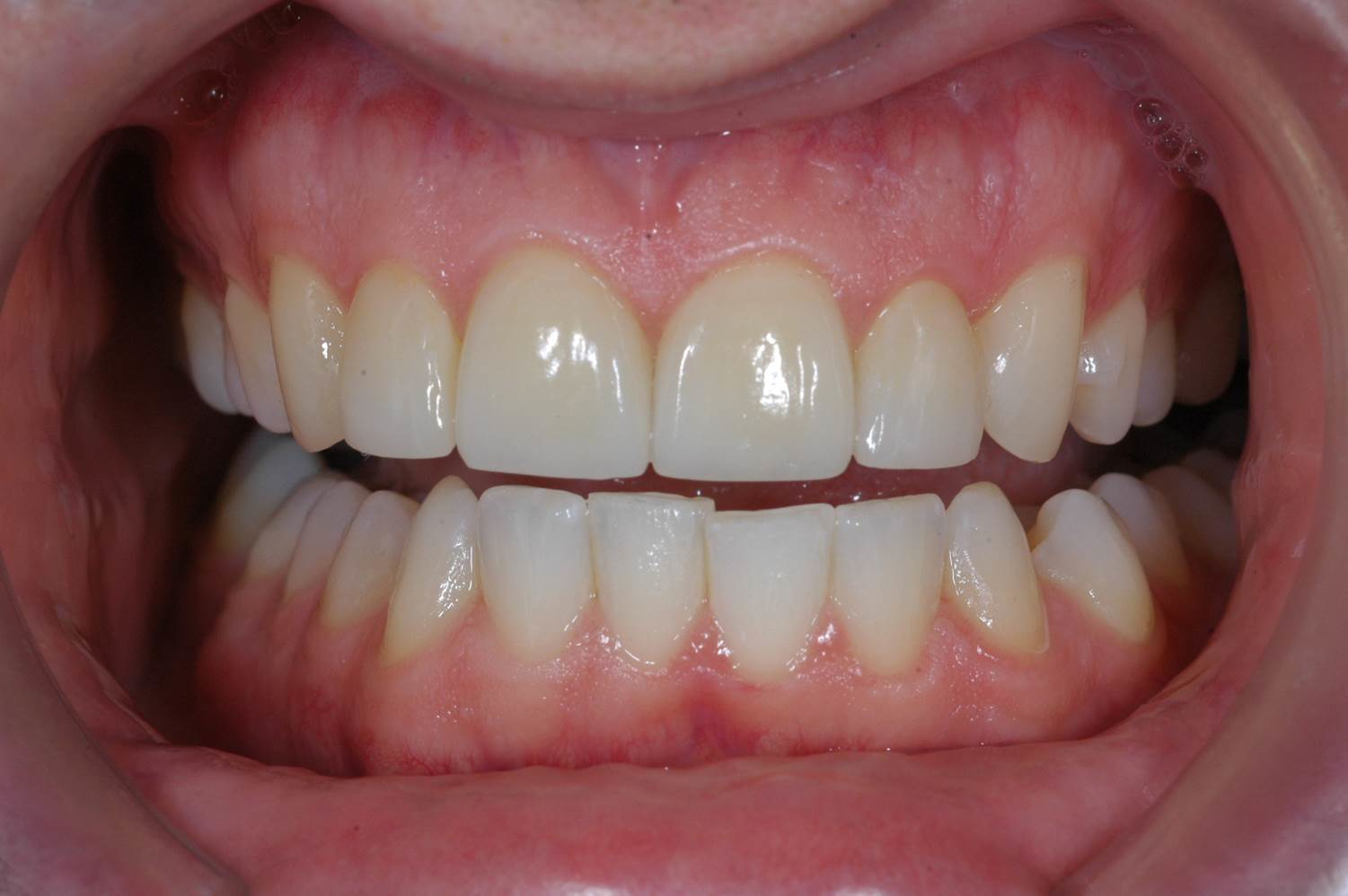 Veneers at Watergate Dental - After