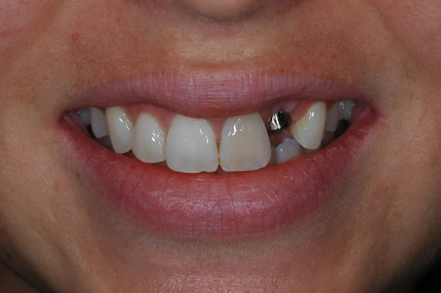 Front tooth implant at Watergate Dental - before