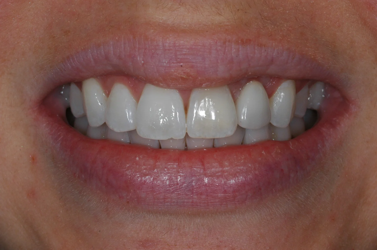 Front tooth implant at Watergate Dental - After