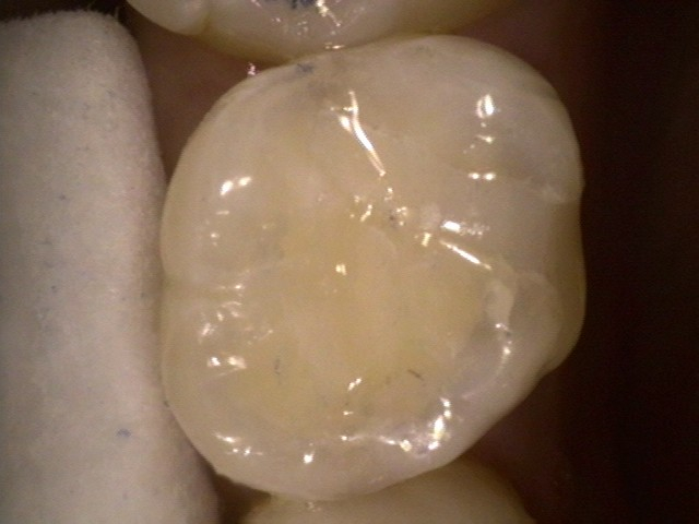 Composite, or tooth-colored filling at Watergate Dental - After