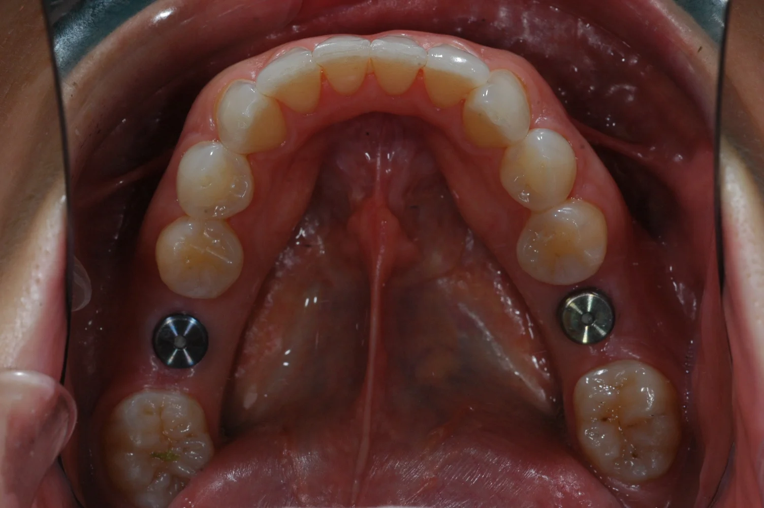 Molar Implants at Watergate Dental - Before 