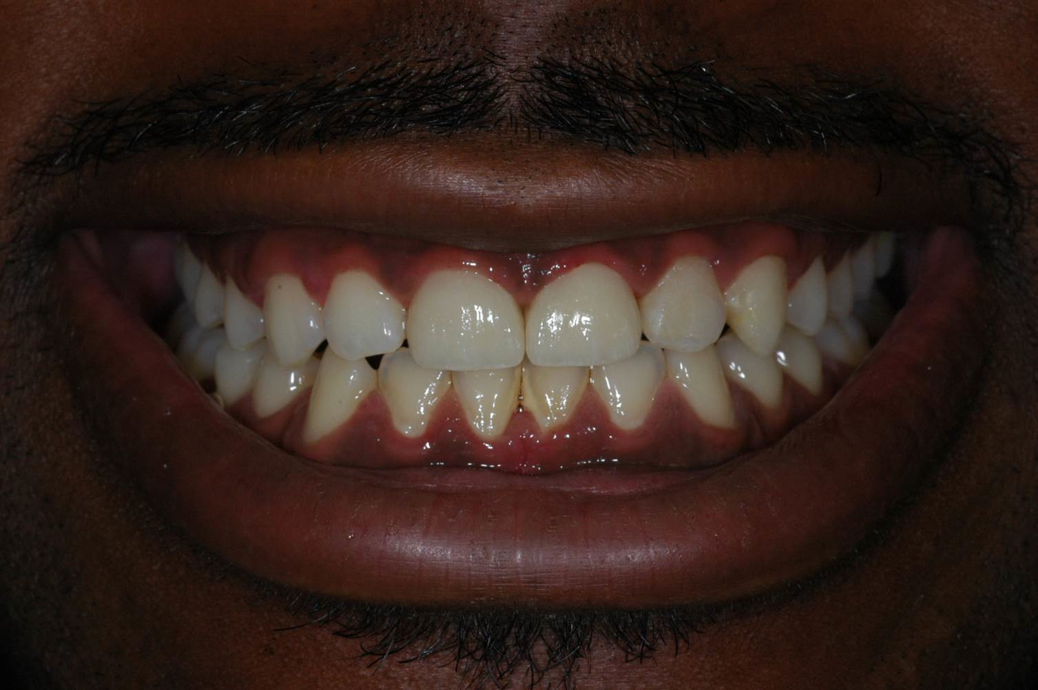 Crowns at Watergate Dental - After