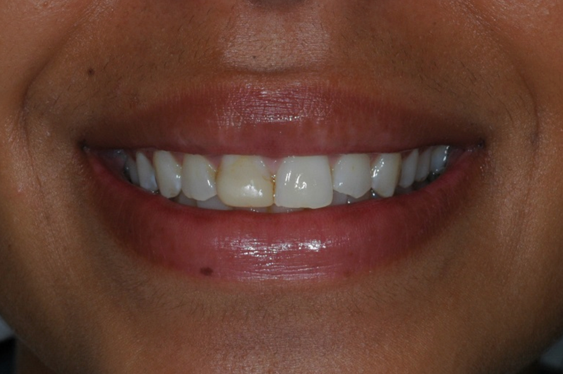 Crown at Watergate Dental - Before
