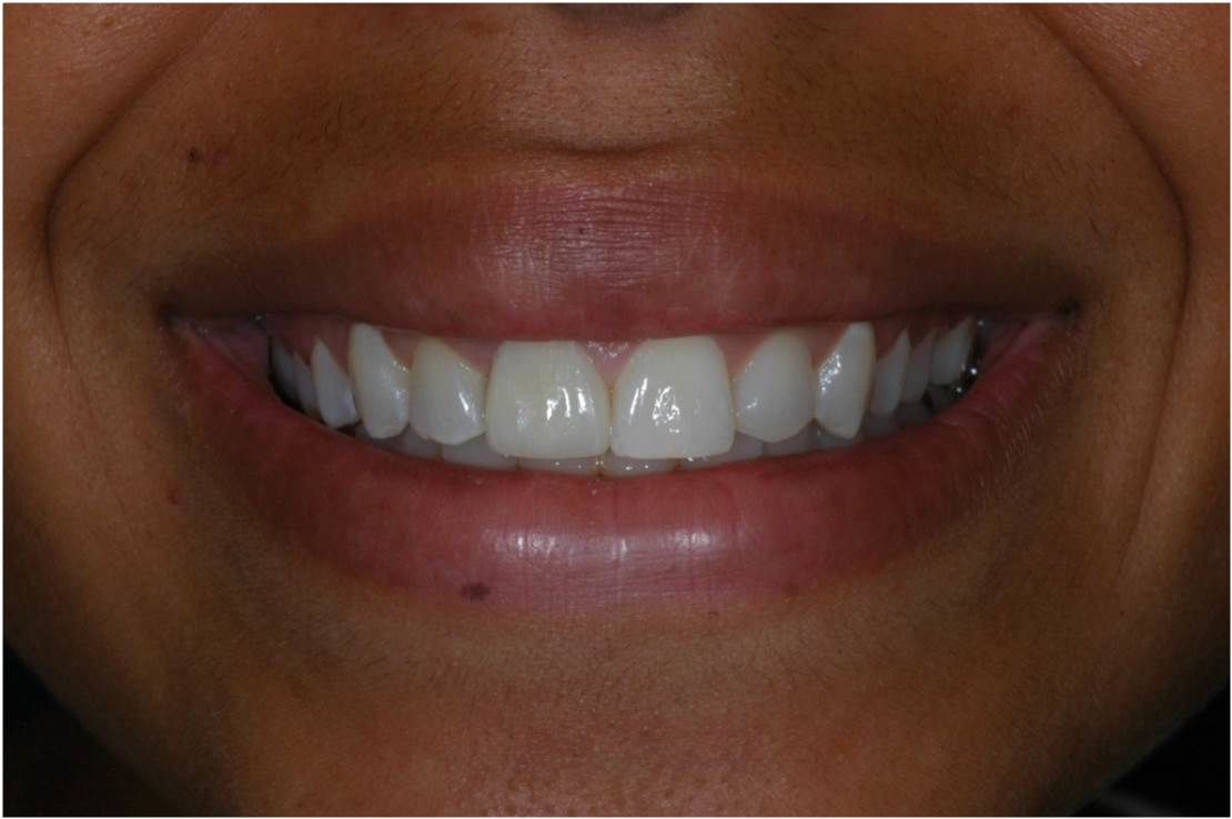 Crown at Watergate Dental - After