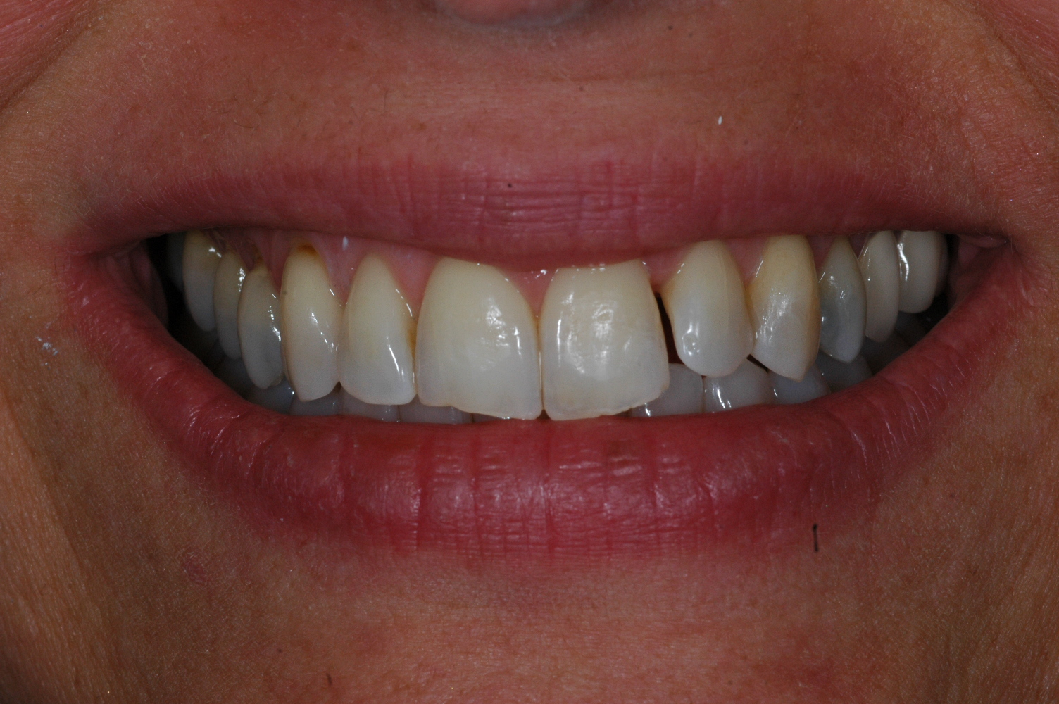 Cosmetic Bonding at Watergate Dental - Before