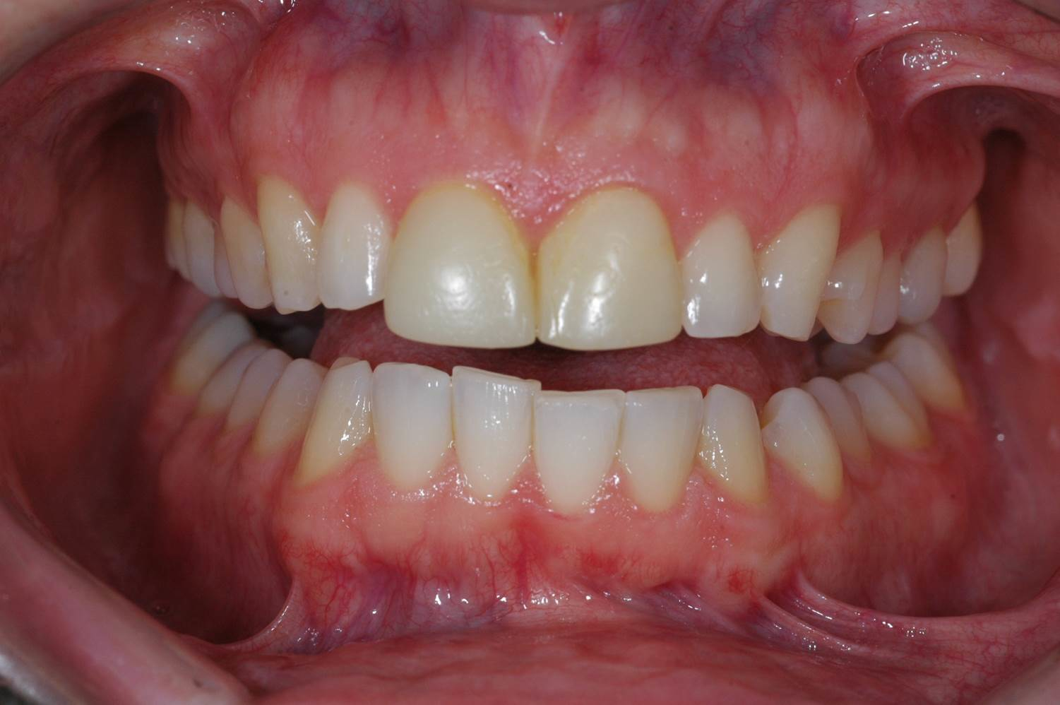 Veneers - Before