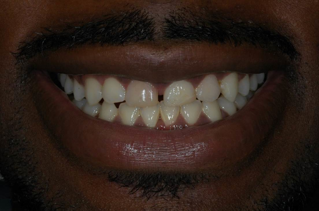 Crowns - Before