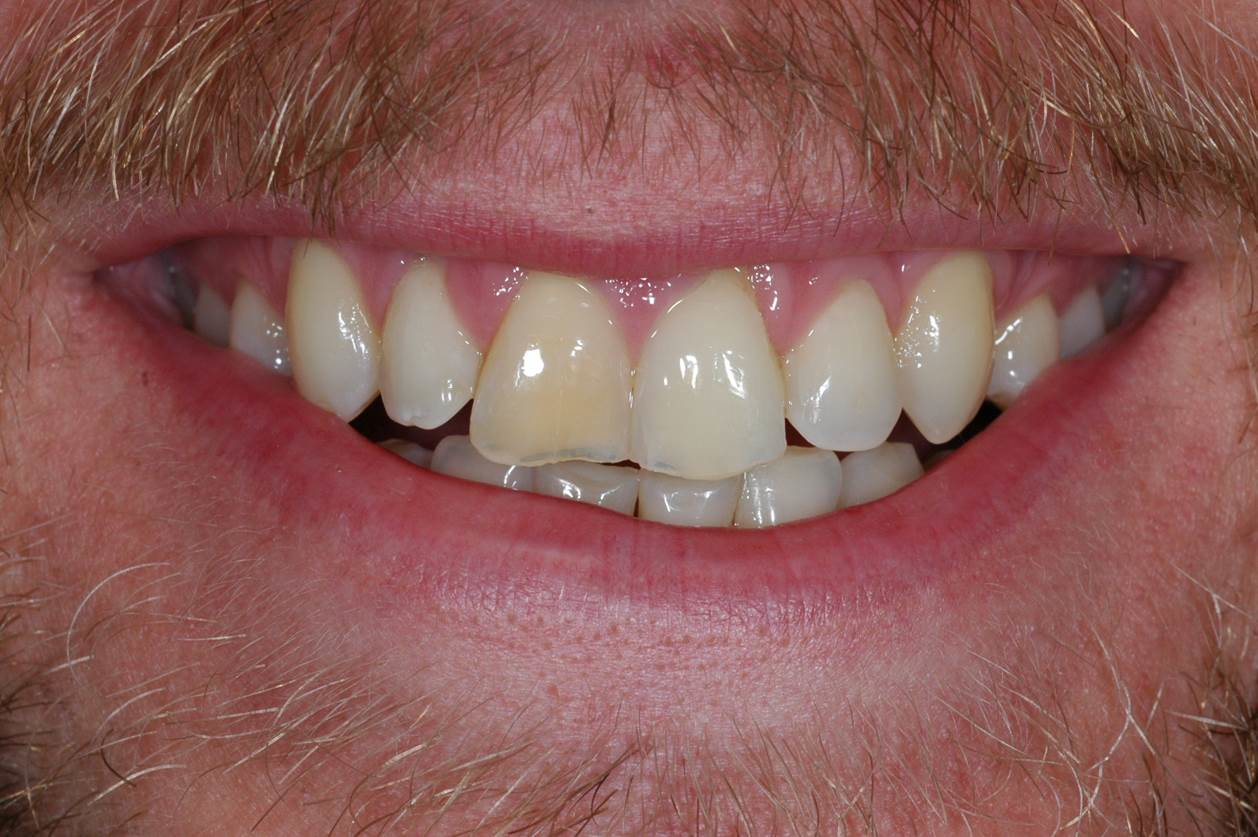Whitening - Before
