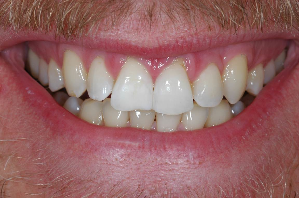 Whitening - After