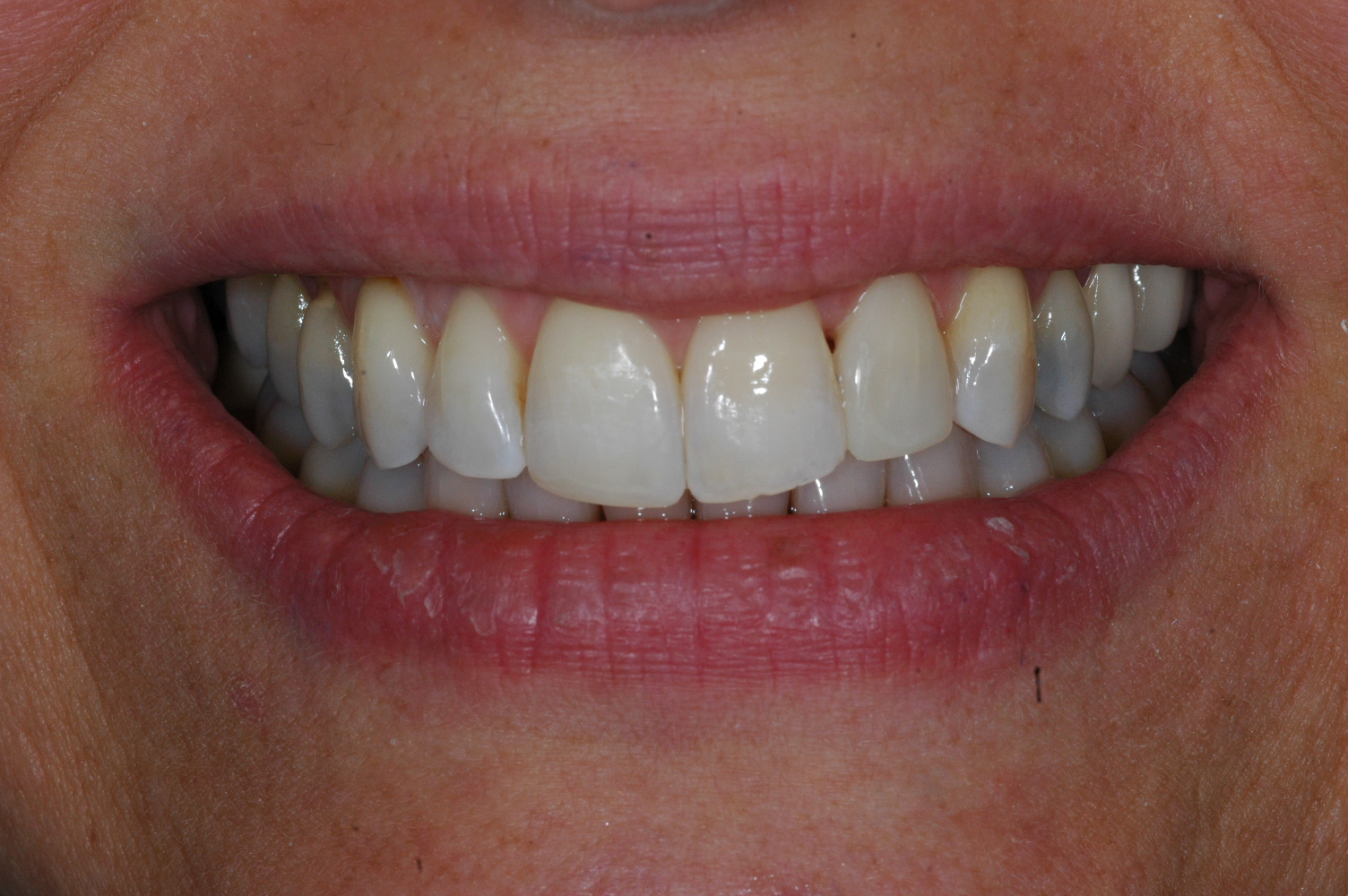 Cosmetic Bonding - After