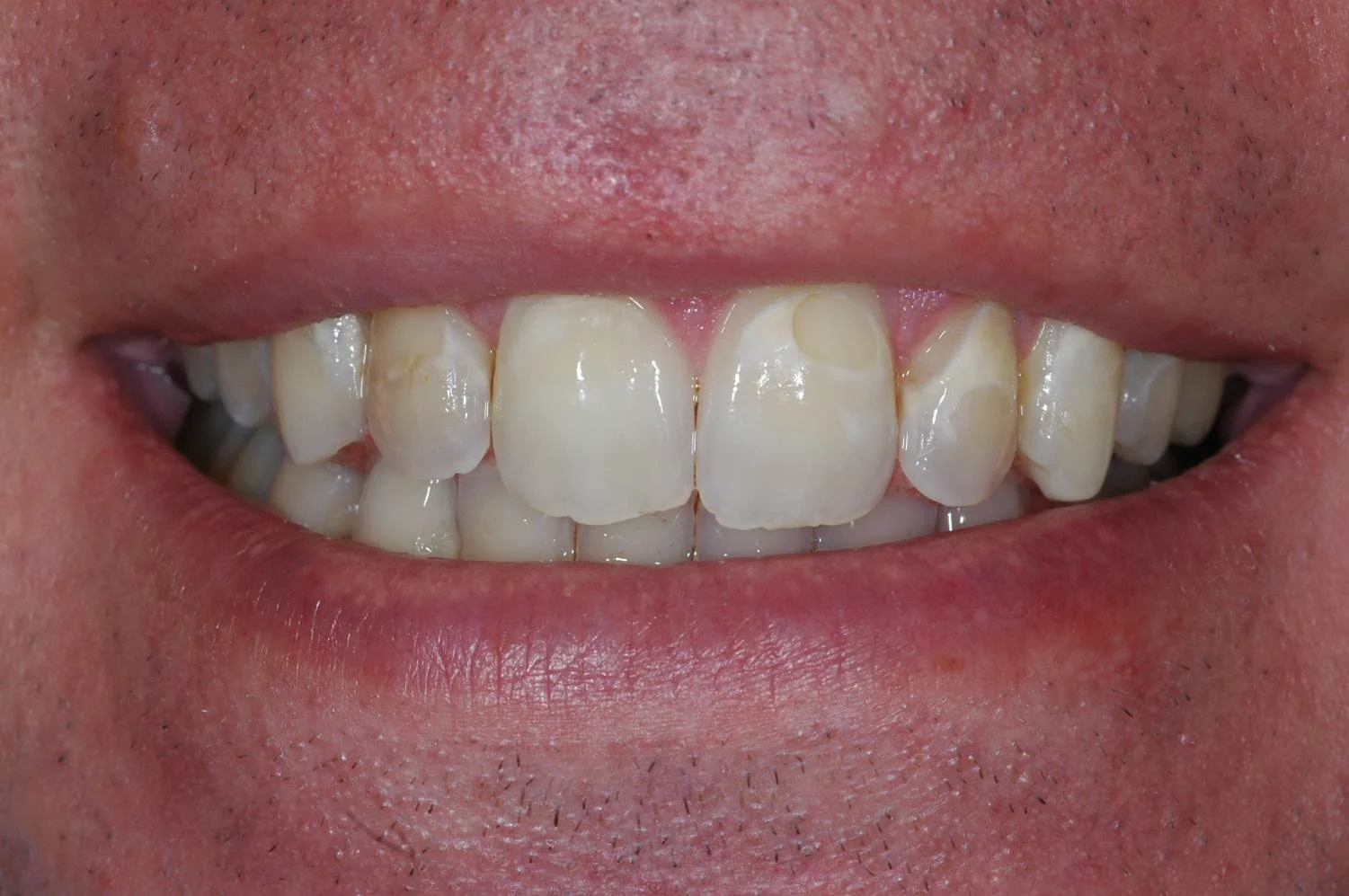 Cosmetic Bonding - Before