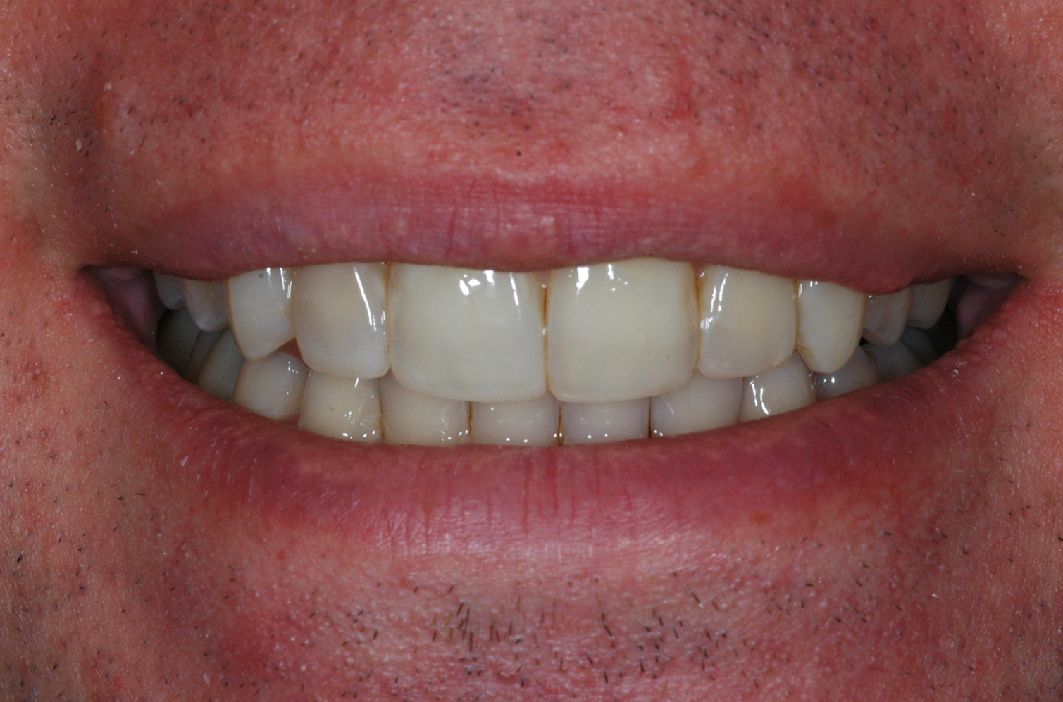 Cosmetic Bonding - After