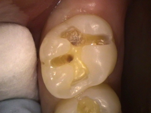 Composite Cavity Filling at Watergate Dental - Before