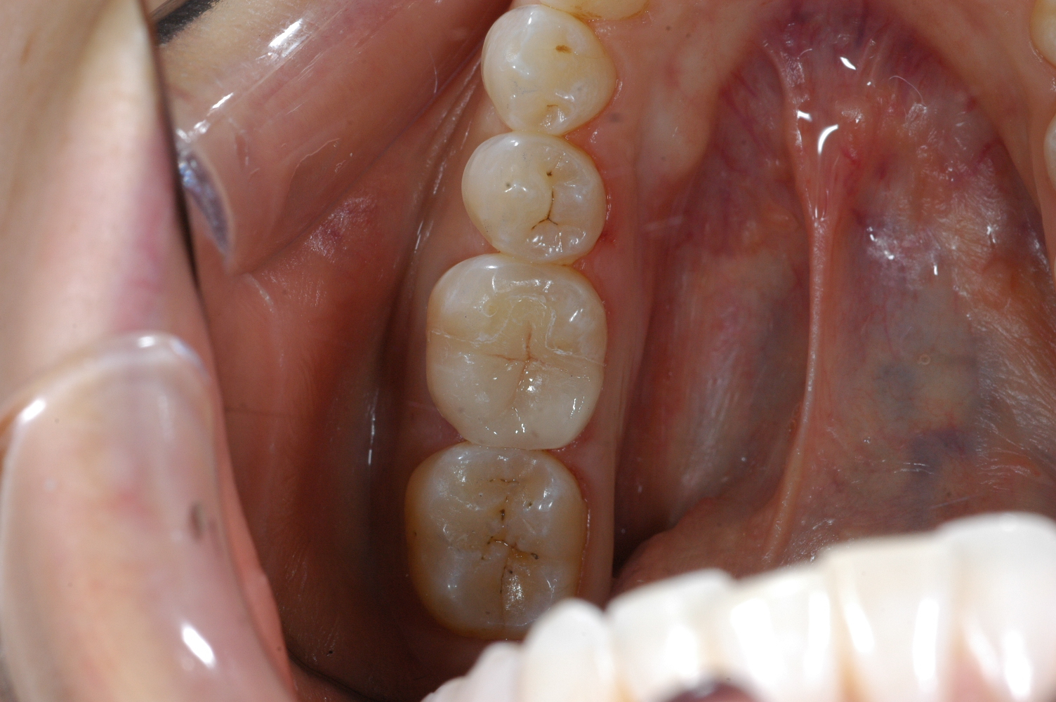 CEREC One-Visit Onlay at Watergate Dental - After