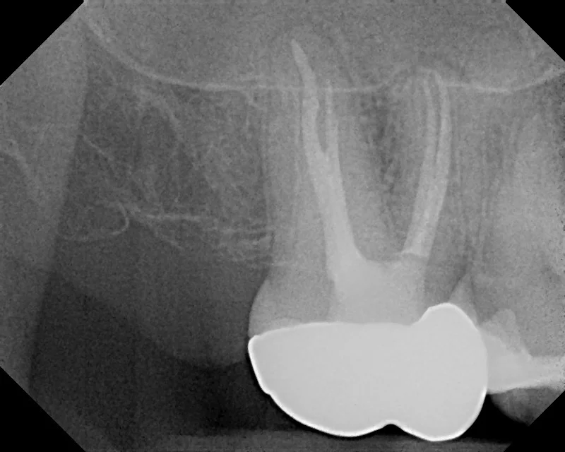 Endodontic (Root Canal) Therapy at Watergate Dental - Radiograph taken after completion of therapy
