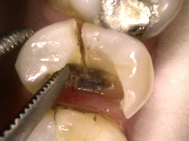 A split tooth requiring extraction & Implant therapy