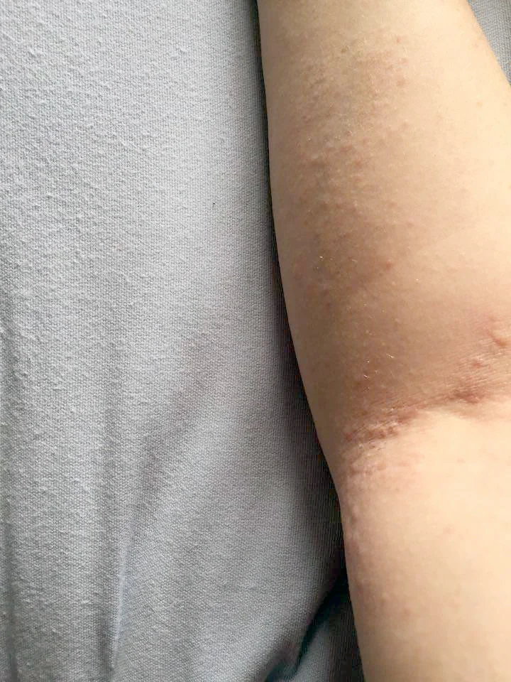 Summer An Eczema Sufferer S Worst Nightmare Gwennan Rees