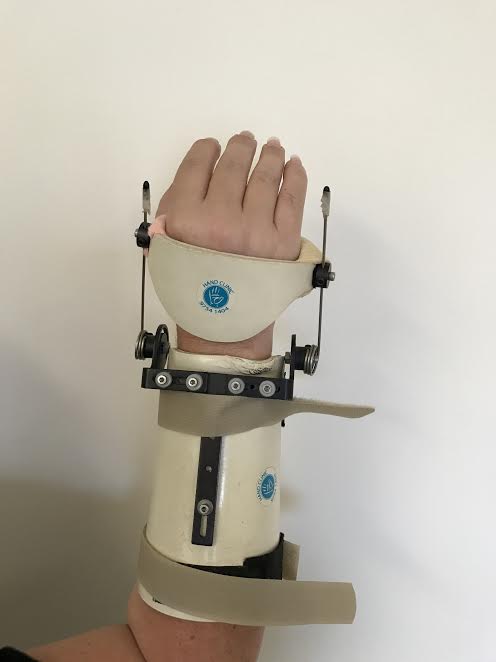 Dynamic Extension Splint