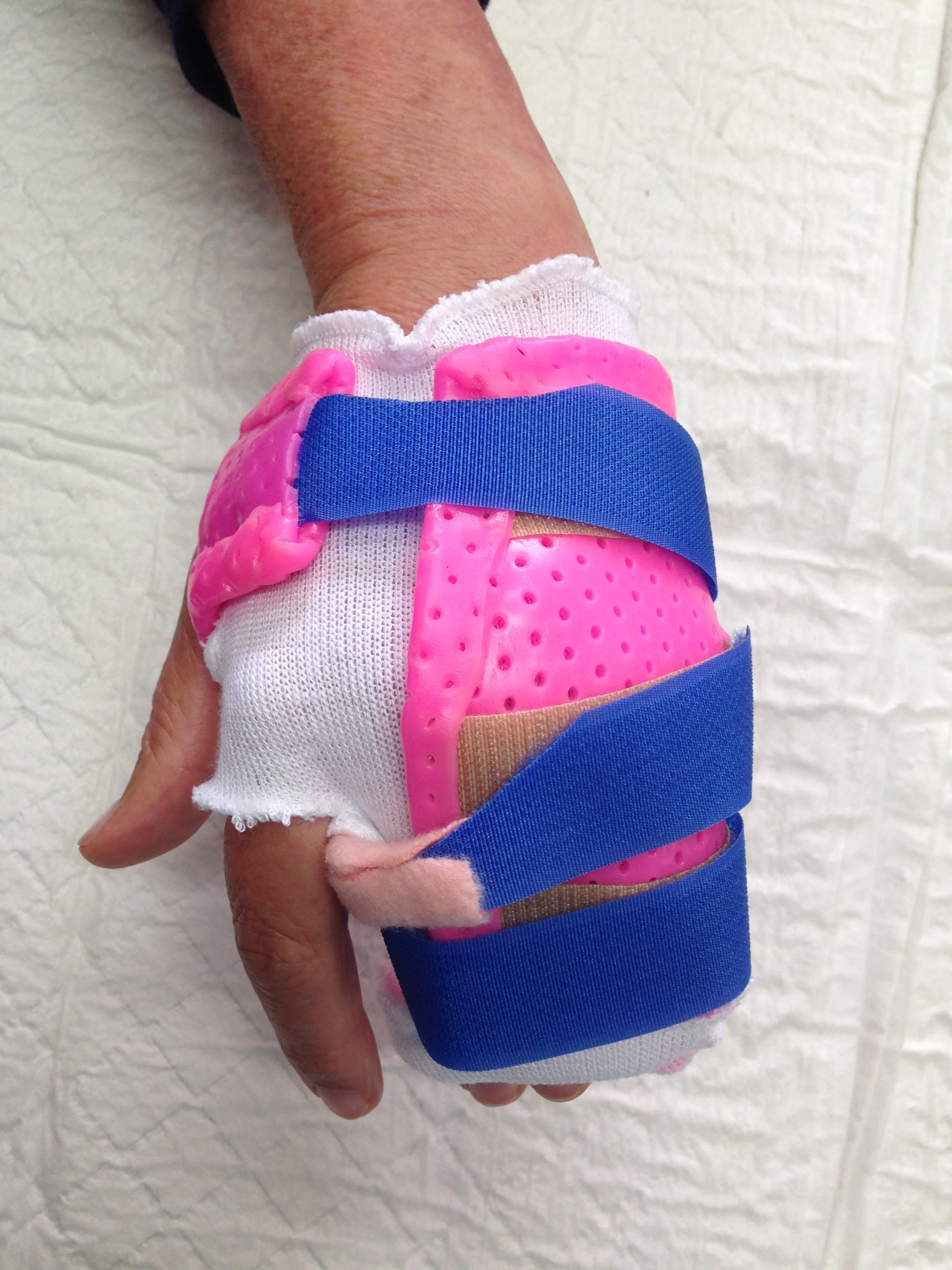 Ulna Digits Immobilisation splint.JPG