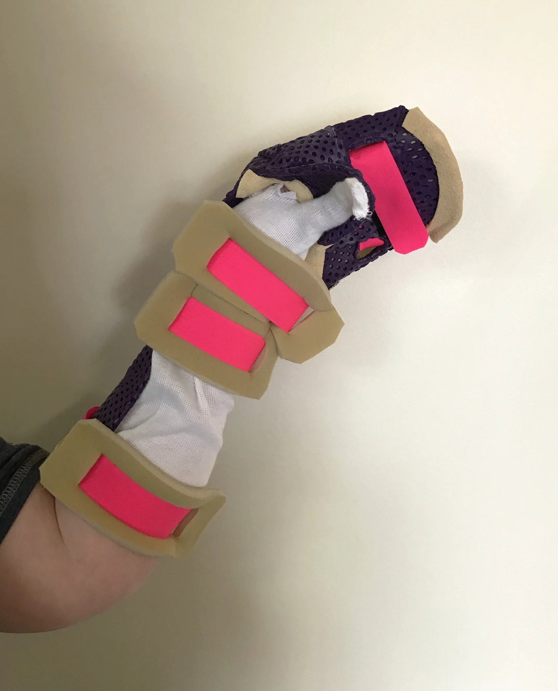 Dorsal-Volar Anti-spasticity splint.JPG