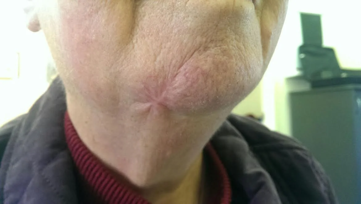 Post Surgical Facial Scar - AFTER