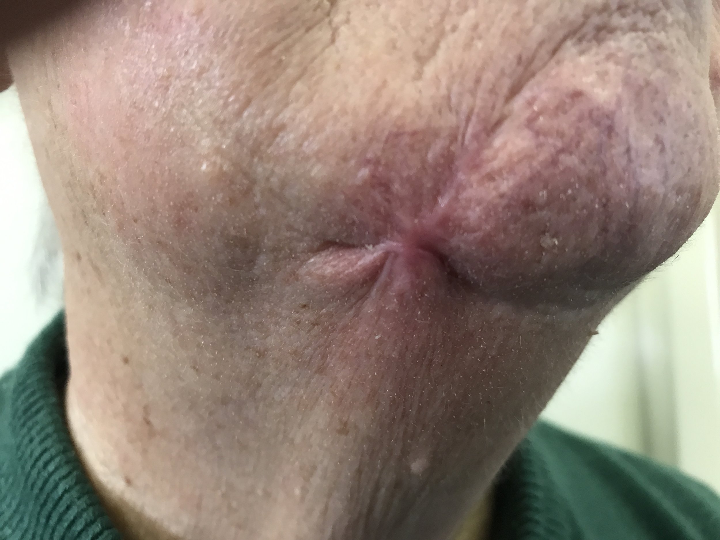 Post Surgical Facial Scar - BEFORE