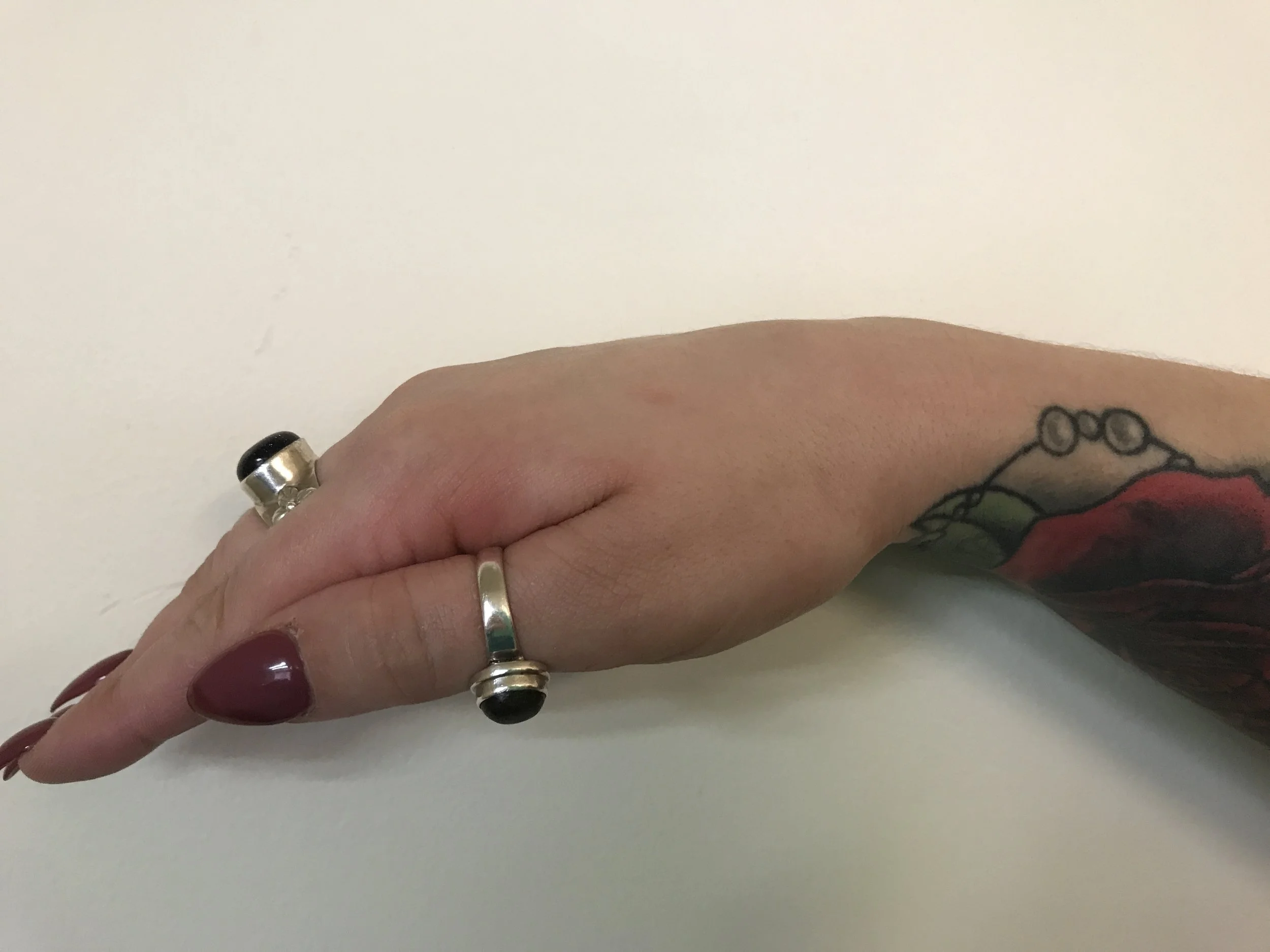 Dorsal Wrist Ganglion