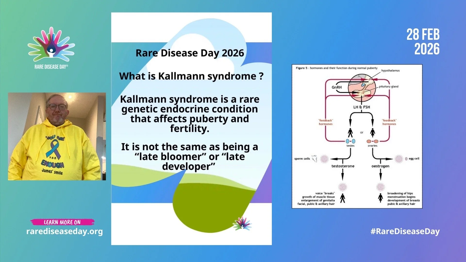 Kallmann syndrome is a rare genetic hormonal disorder that affects puberty and fertility. Patients with Kallmann syndrome experience absent or partial puberty.