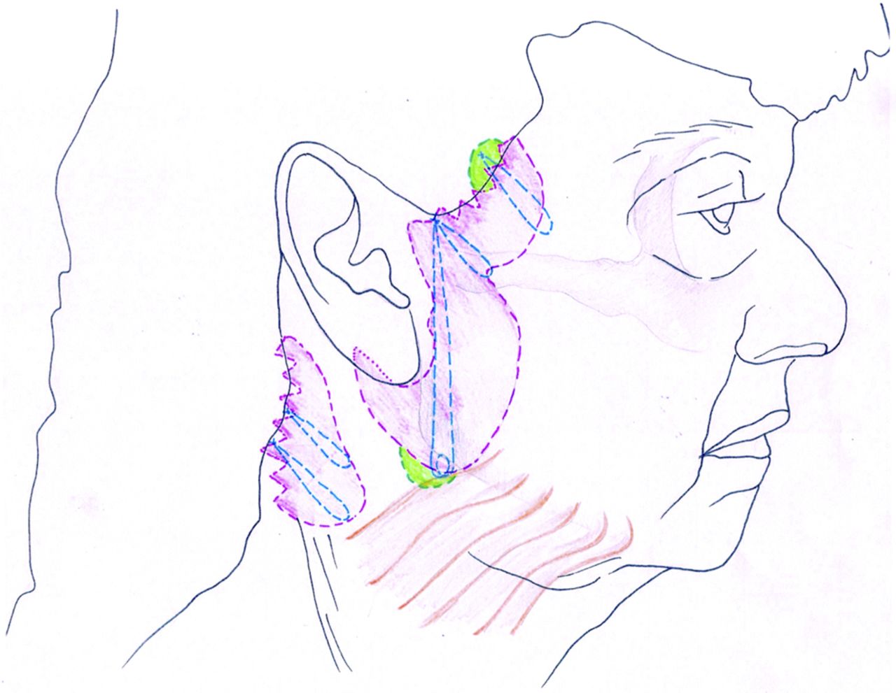 Figure 2. -&nbsp;This illustration highlights the main areas addressed in the posterior cervicoplasty technique. “U” suture: MACS-like SMAS plication from temporal fascia above zygomatic arch, includes posterior edge of platysma. “O” suture: dermis …