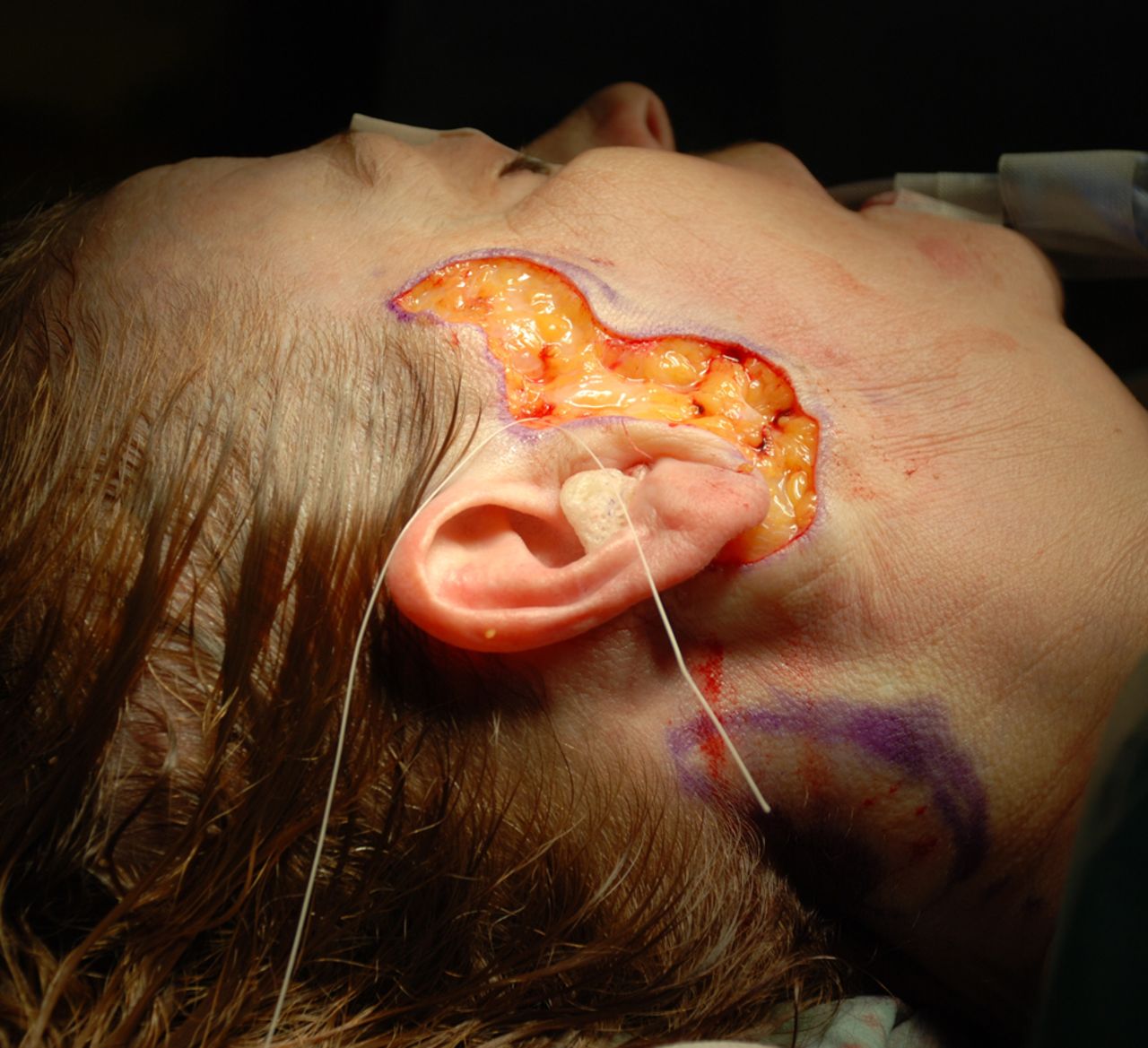 Figure 3. -&nbsp;Intraoperative view of one of the skin excisions.