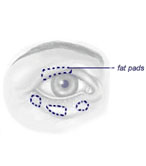 Bags are caused by an accumulation of fat and with age the skin stretches and the muscles around the eye weaken.