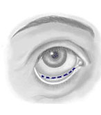 Transconjunctival blepharoplasty- incision made inside.