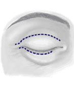 In a typical eyelid reduction operation incisions lines follow the natural lines of the eyelids.