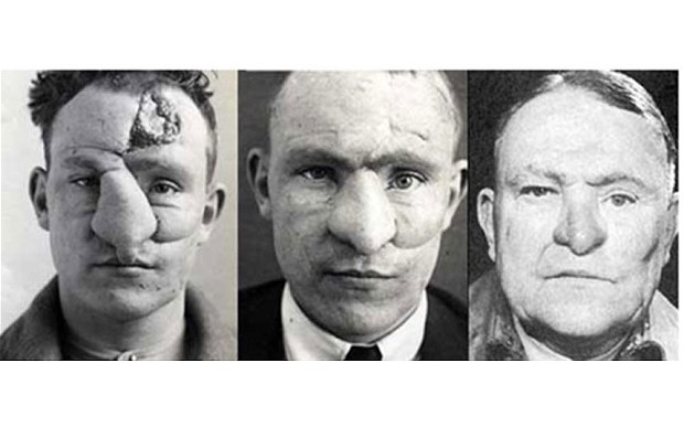 William M. Spreckley, Gillies’ 132nd patient. His nose was treated using a tube pedicle