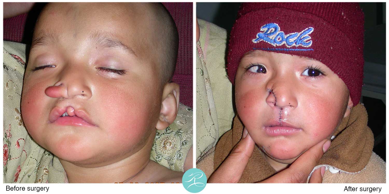 Cleft lip and nose