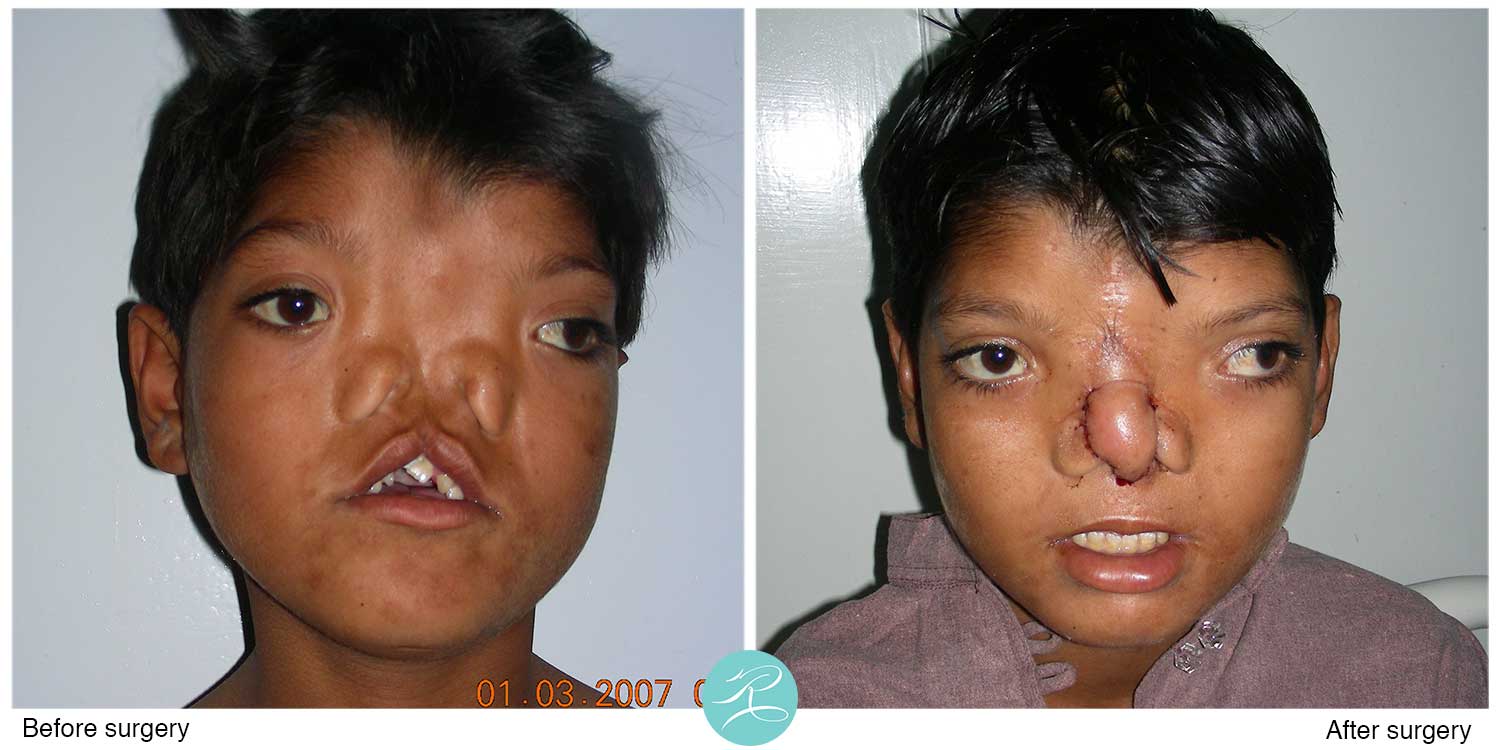 A difficult cleft lip and nose reconstruction case, after four operations