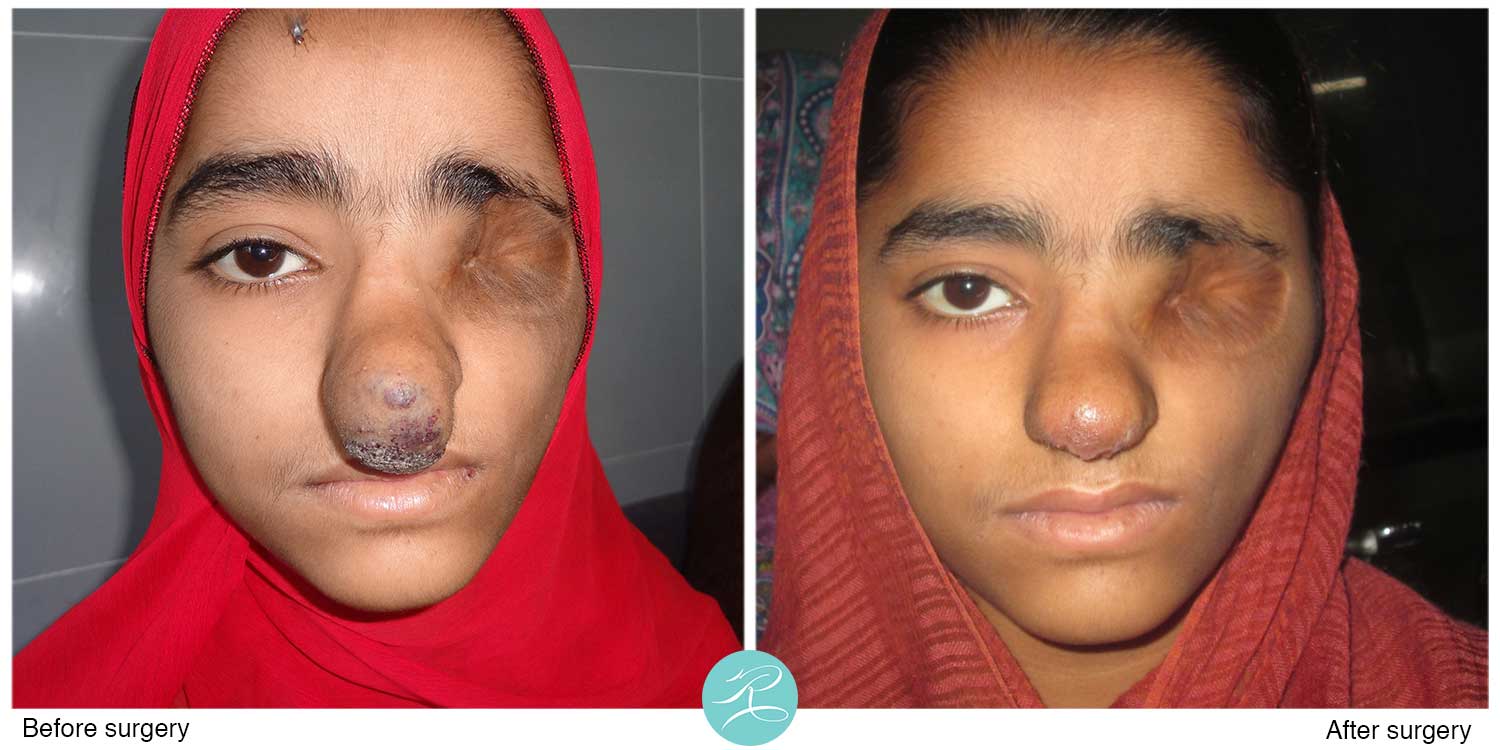 Young girl with vascular malformation of nose, three weeks after the operation, awaiting prosthetic eye to be arranged by OPSA