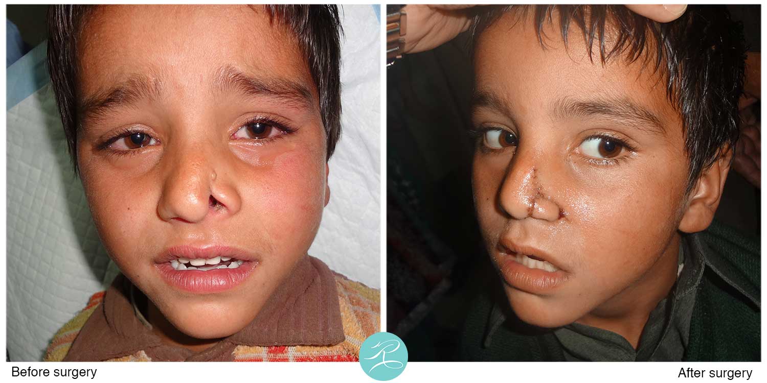 Cleft nose deformity, reconstructed with local re-positioning of the tissue,  three weeks after the operation.