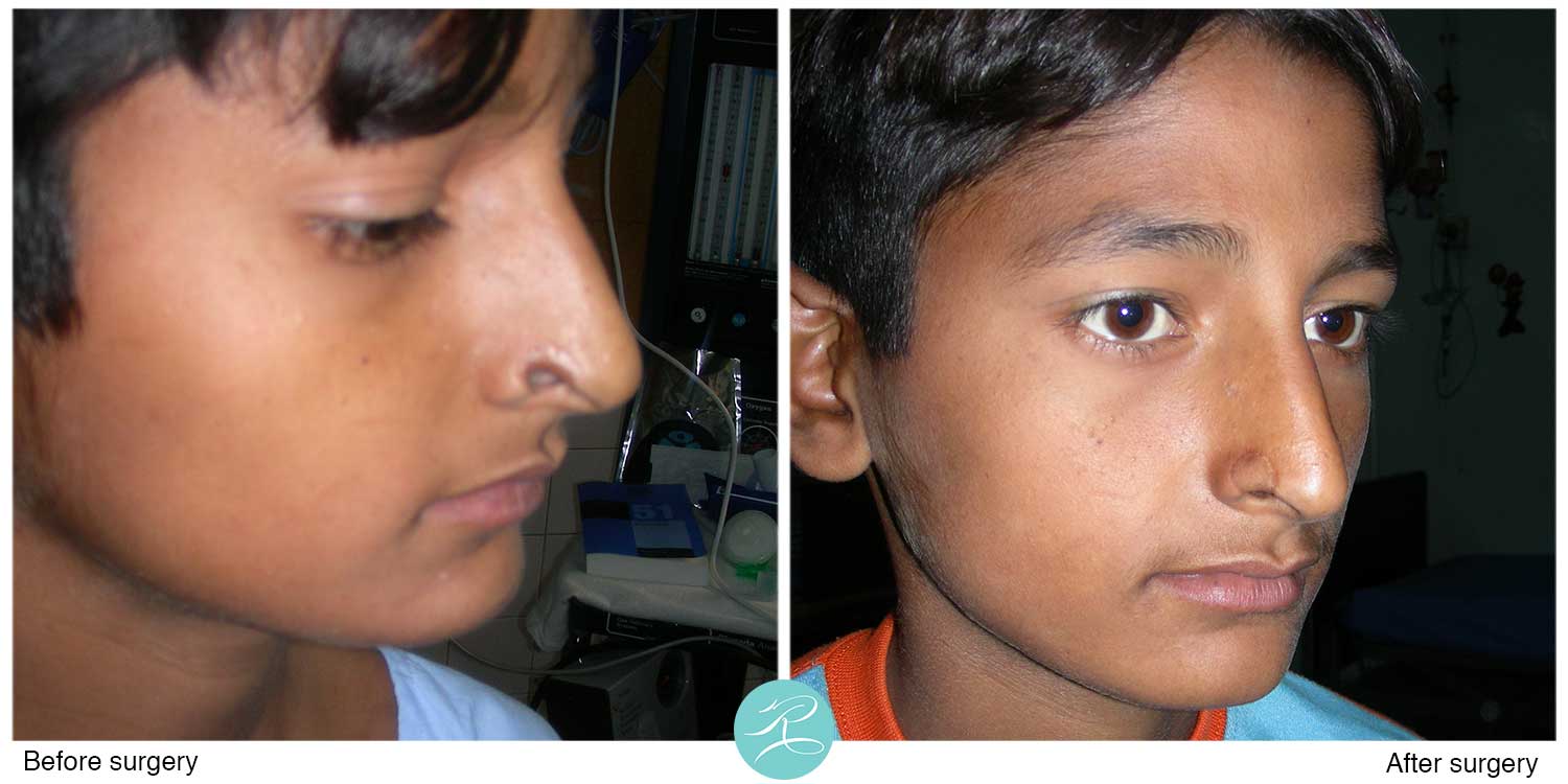 Nose defect reconstructed with composite graft from ear