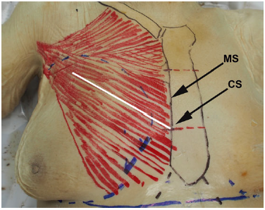 Figure 1. Markings before dissection of this 89-year-old female cadaver. The sternum and clavicle are marked in black, the pectoralis major is marked in red, and the gland boundaries and inframammary folds are in blue. The white line depicts the path of a biplane muscle split. CS, lateral junction of the middle and caudal one-third of the sternum. MS, midpoint of the sternum at its lateral border. The mean distance to the most medial nerve branch was consistently shorter from MS than from CS.