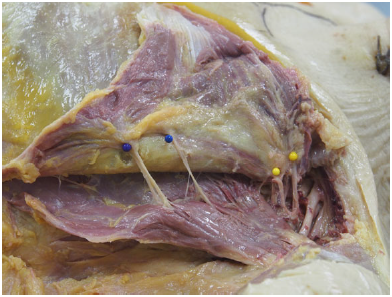 Figure 2. Right lateral view of a pectoral dissection in this 89-year-old female cadaver. The pectoralis major and minor have been detached superolaterally, and the entry sites of major nerves into the pectoral musculature are marked with pins.