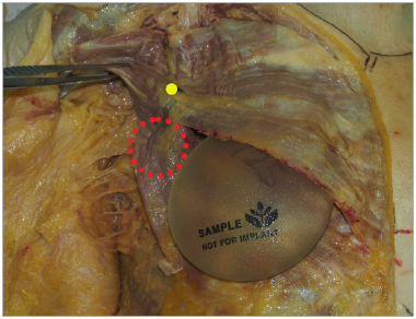 Figure 3. Placement of a round implant in a biplanemuscle-splitting pocket in this 89-year-old female cadaver. The upper medial portion of the implant is submuscular. The yellow dot indicates the entry site of the most medial nerve branch into the p…