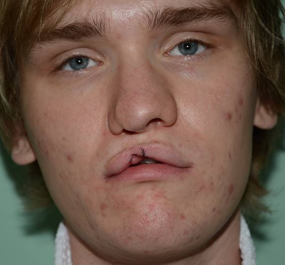 Hull boy helps 10 children with cleft lip and palate-Journal-Mr M ...