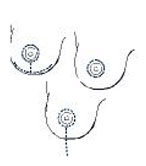 Different types of scarlines after breast uplift (mastopexy) surgery