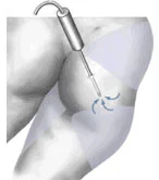 A narrow metal tube is inserted through a small incision in the nearby skin