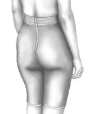 A snug pressure garment is worn after surgery around the lower part of the body to help reduce swelling