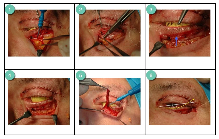 Volume augmentation steps of an upper and lower blepharoplasty procedure by Mr Riaz Cosmetic Surgery Hull & East Yorkshire 