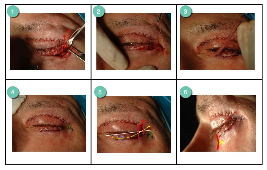 Immediate post-operative results of an upper and lower blepharoplasty procedure by Mr Riaz Cosmetic Surgery Hull & East Yorkshire